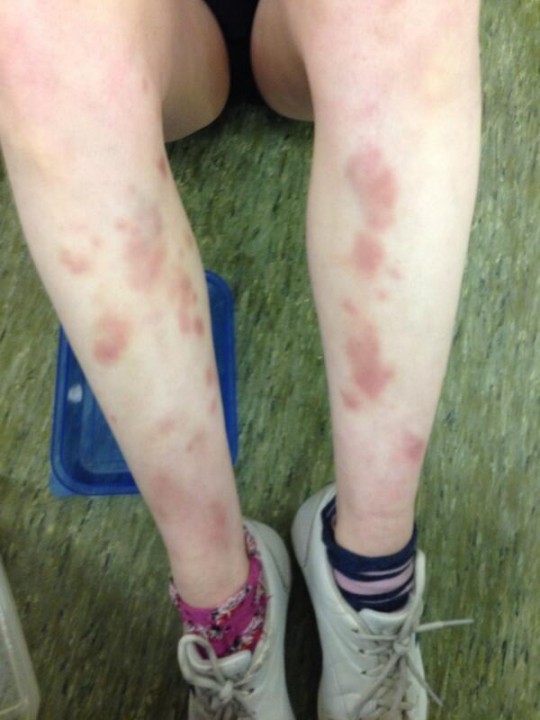 bruises (1)