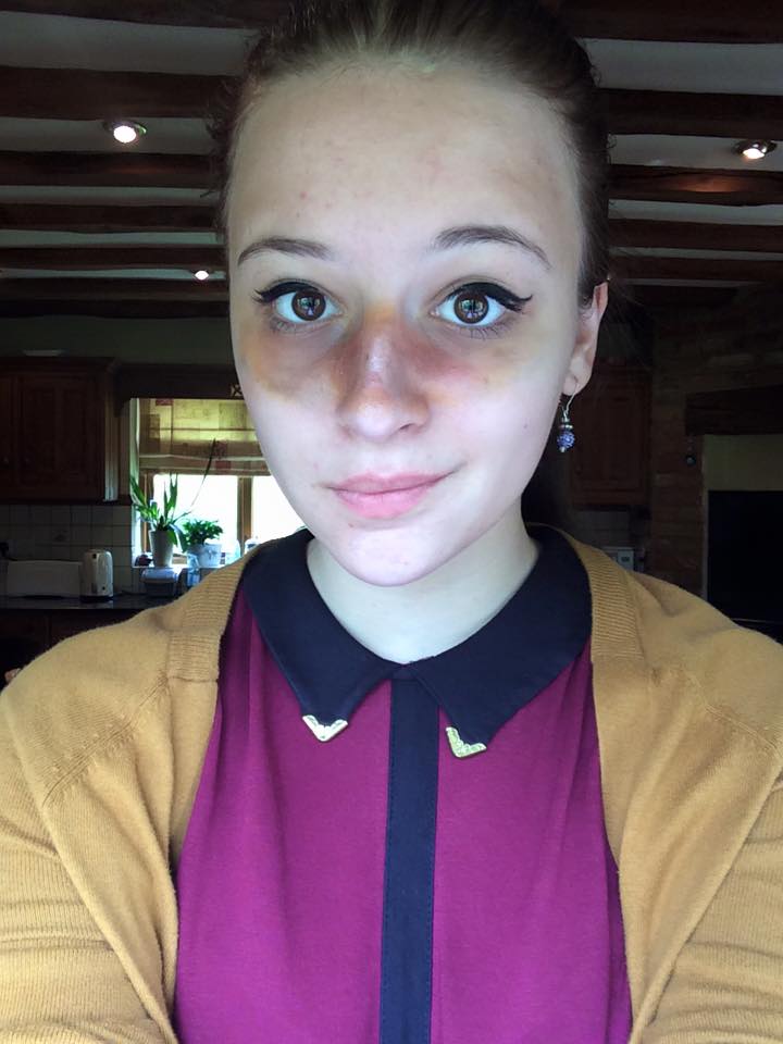 Match your bruises to your clothes