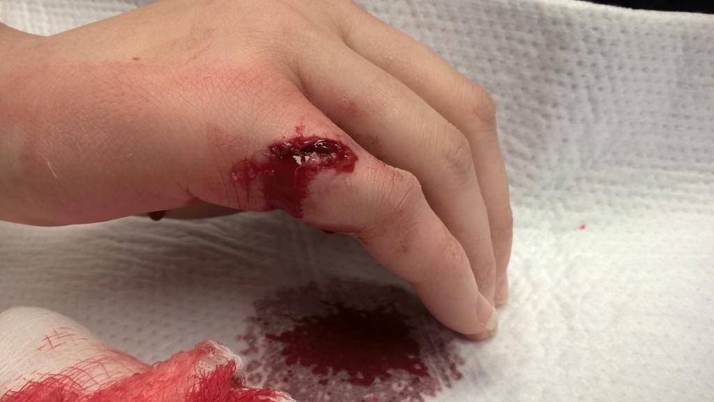 Zeenah sustained a finger injury while working on "Henry V"