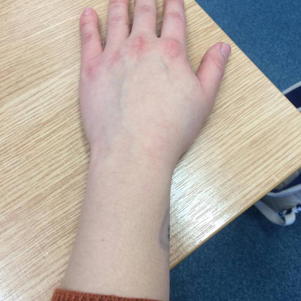 My wonky lungs just poking round the side of my wrist
