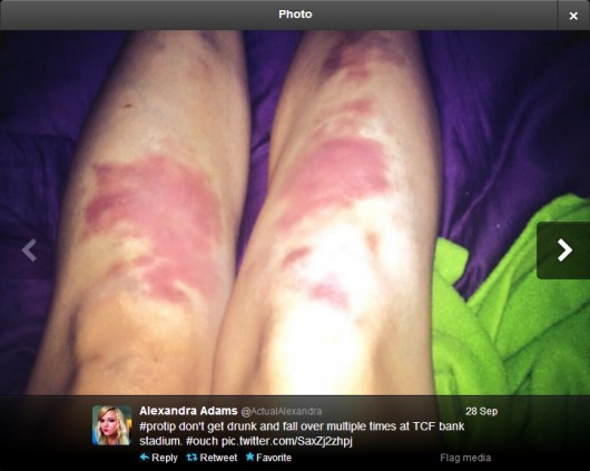 No one wants to wake up with bruises like this...