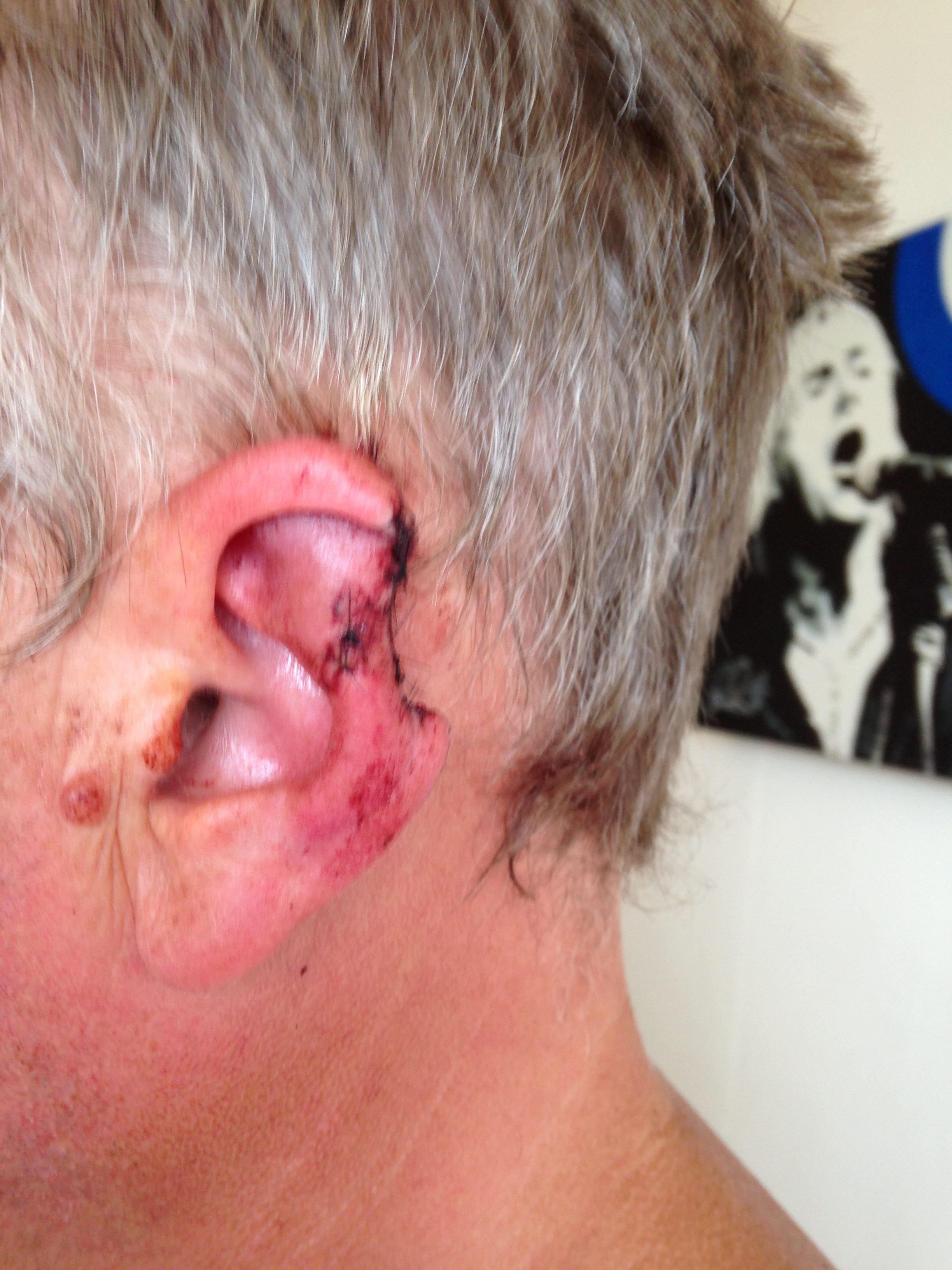NTI_EAR_BITE_05