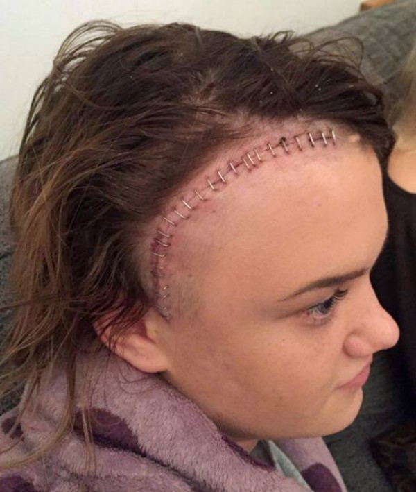 Maddy needed 30 staples in her head