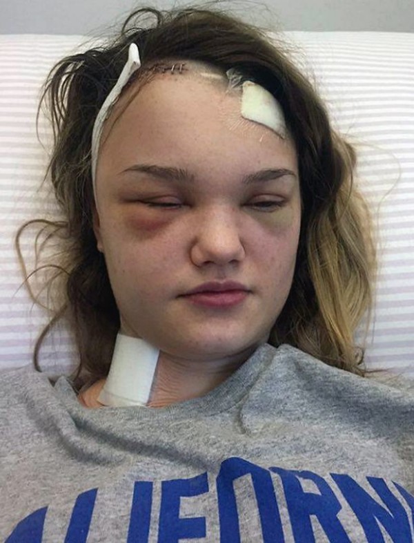 The student nurse had part of her skull drilled out