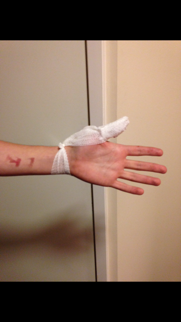 On the left we see the failed brand and on the right the bandaged up thumb. Diagnosis: idiot