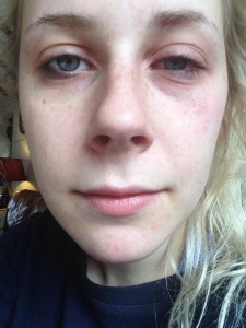 Swollen eyes are a symptom of conjunctivis