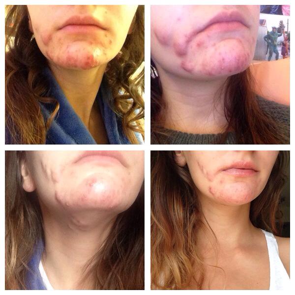 (top left to right) March, April, (bottom left to right) May (start of medication), July (6 weeks in)