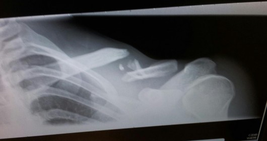 Collarbone break