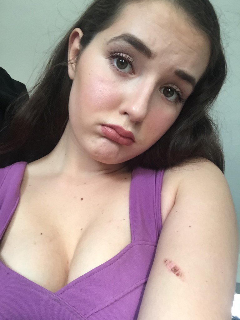 Me feat. burnt arm