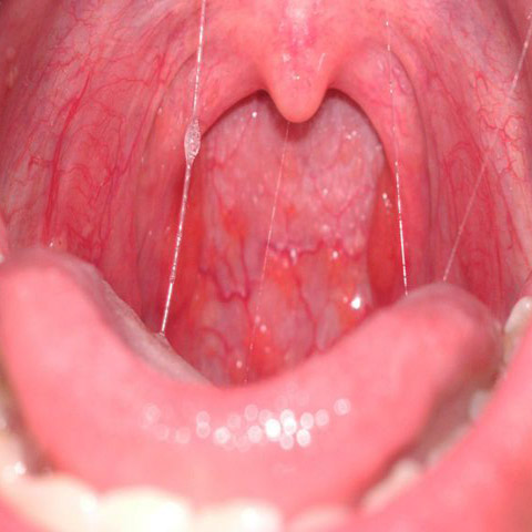 throat-cancer-picture-liv-tyler-cumshot