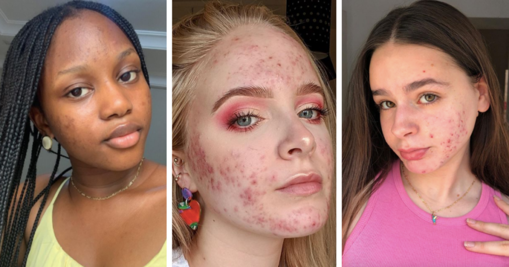 acne, instagram, influencers