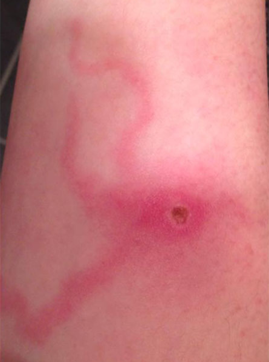Poisonous: poor Bronwyn was bitten by a venomous spider in her bed