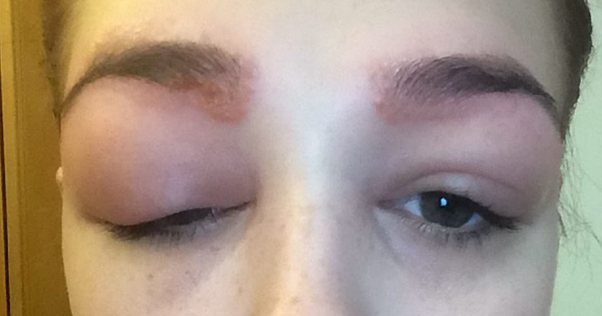 Eyes dyed shut Teenager left scarred after disastrous eyebrow treatment