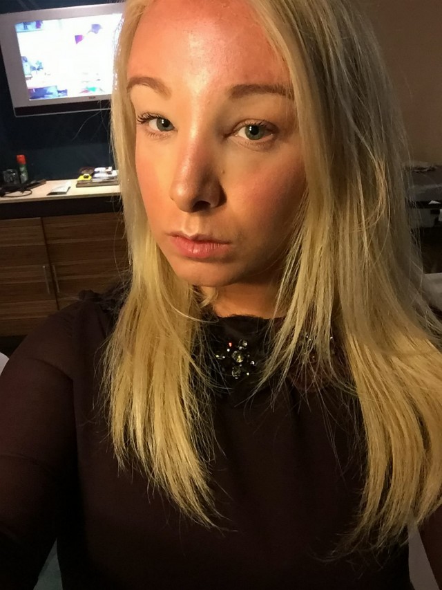 Katie after using the cream
